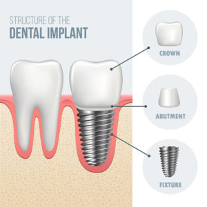 Structure of Dental Implant