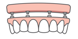 A full arch of teeth being replaced with dental implants
