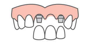 Multiple teeth being replaced on an arch of teeth