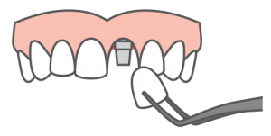 a single dental implant being placed onto an upper arch
