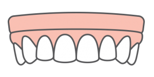 An illustration of implant-supported dentures